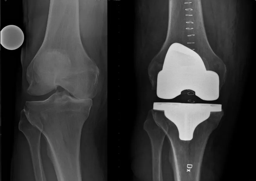 X-ray image of two knee joints. The x-ray image to the left shows a knee affected by osteoarthritis and the x-ray image to the right shows a knee with a prosthesis.